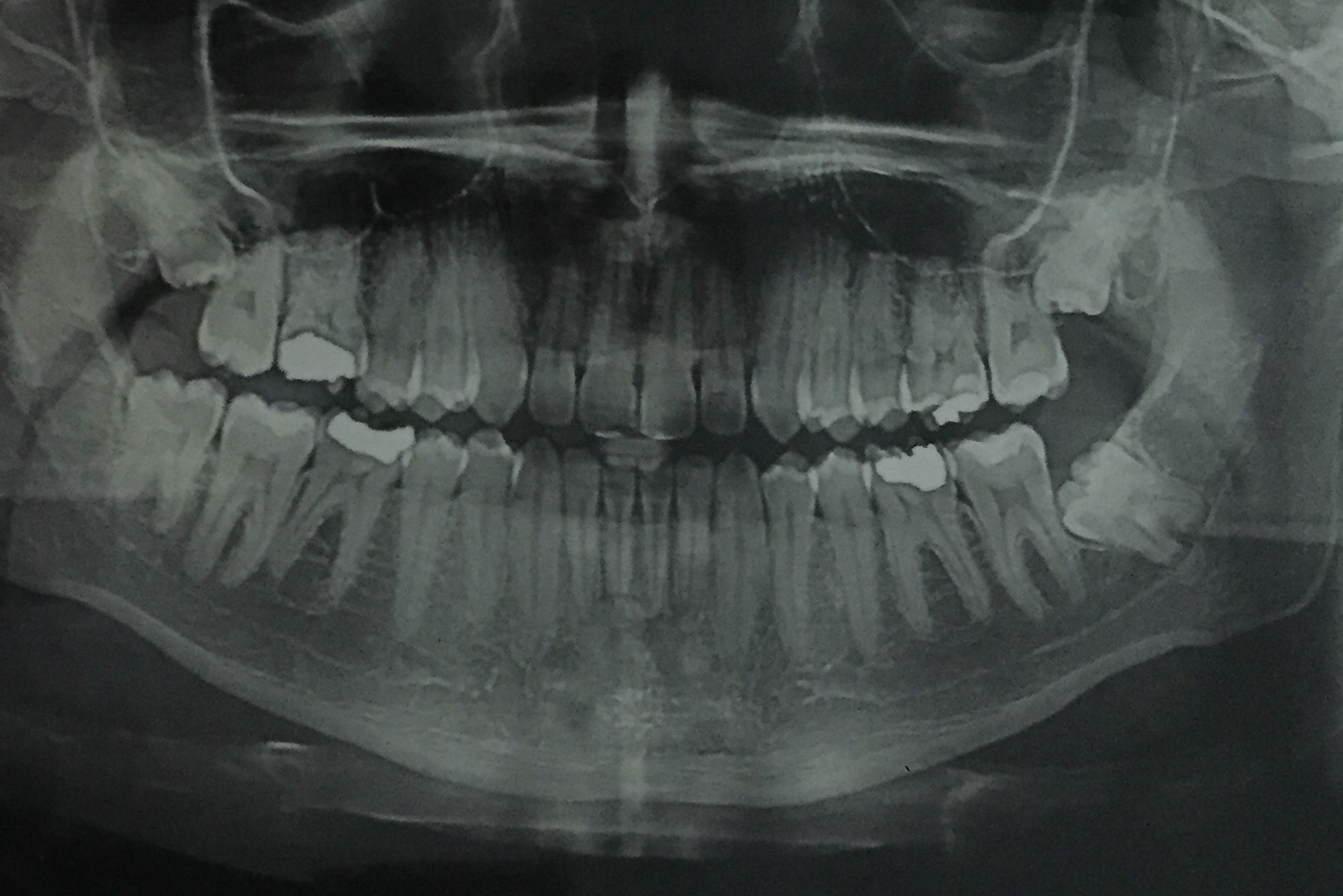اشعة بانوراما الاسنان