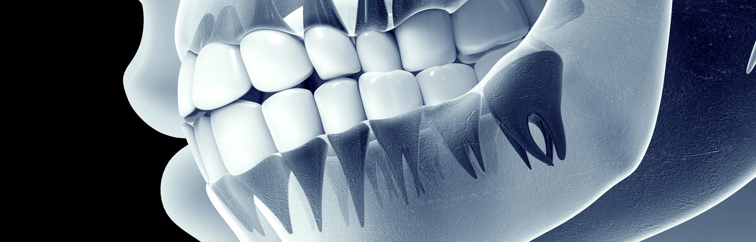 تكلفة اشعة بانوراما للاسنان